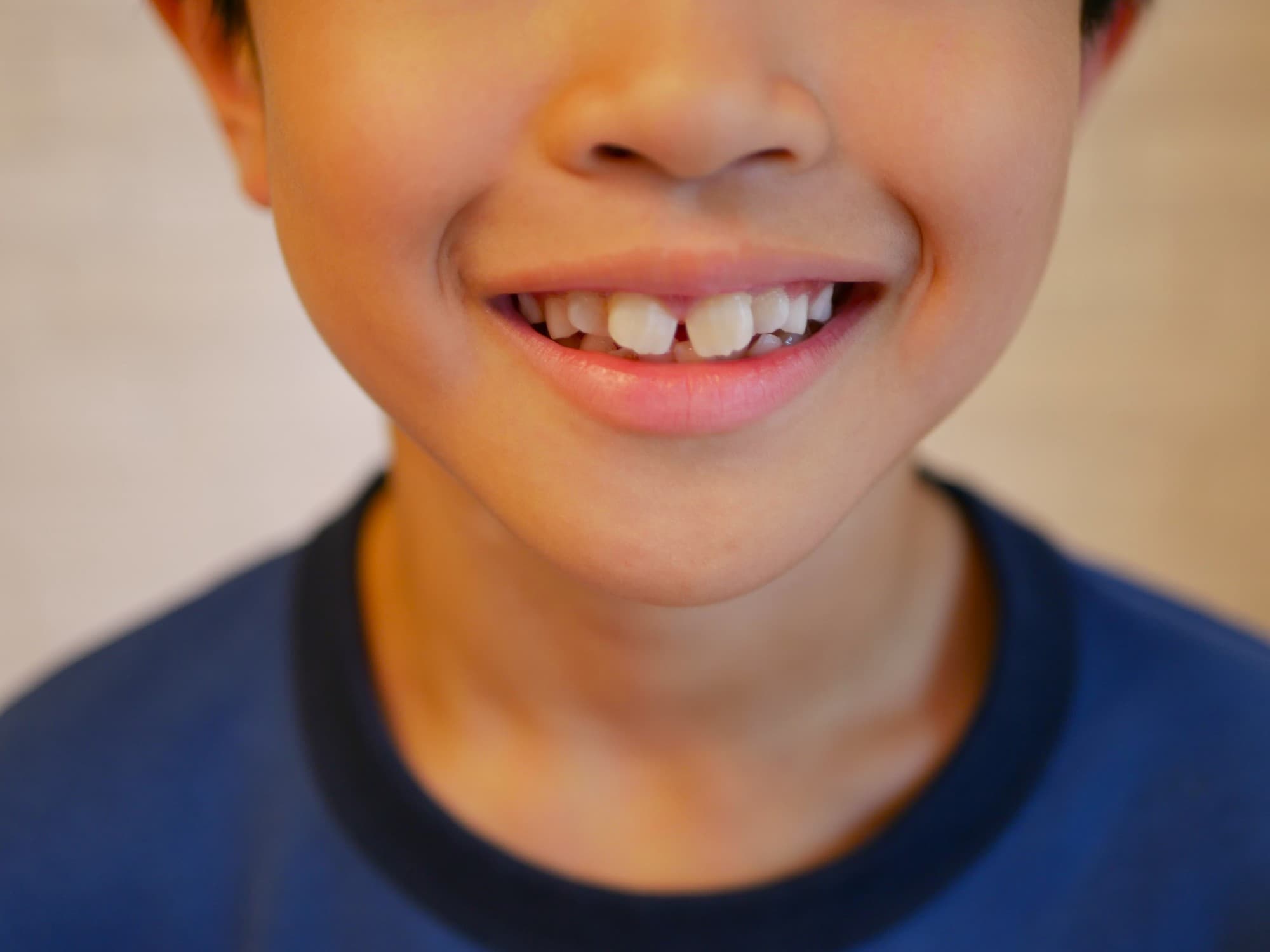 すきっ歯の前歯