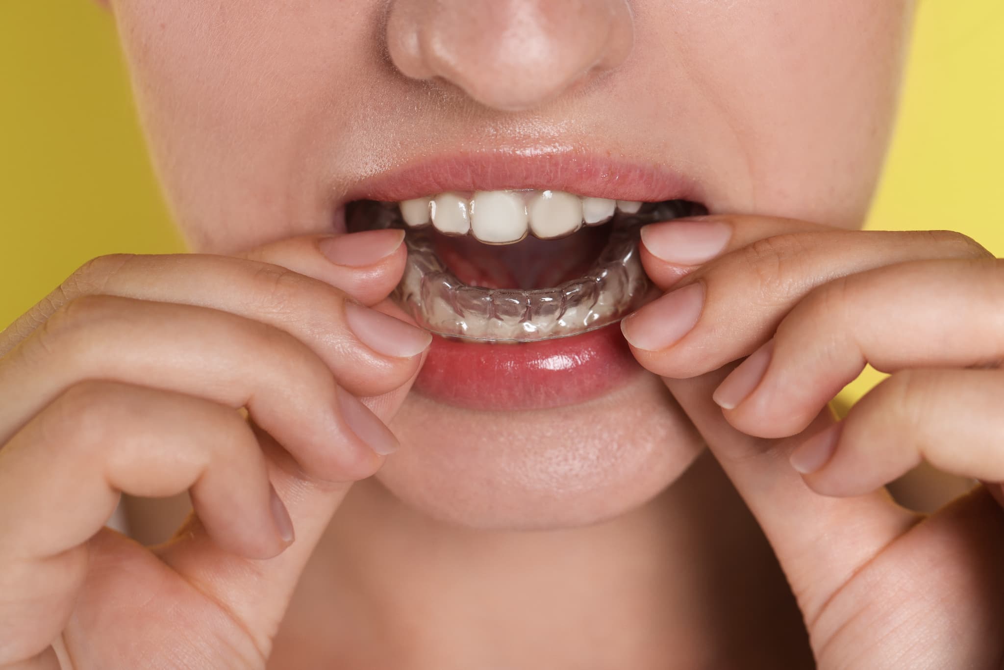 インビザラインを装着しようとしているイメージ