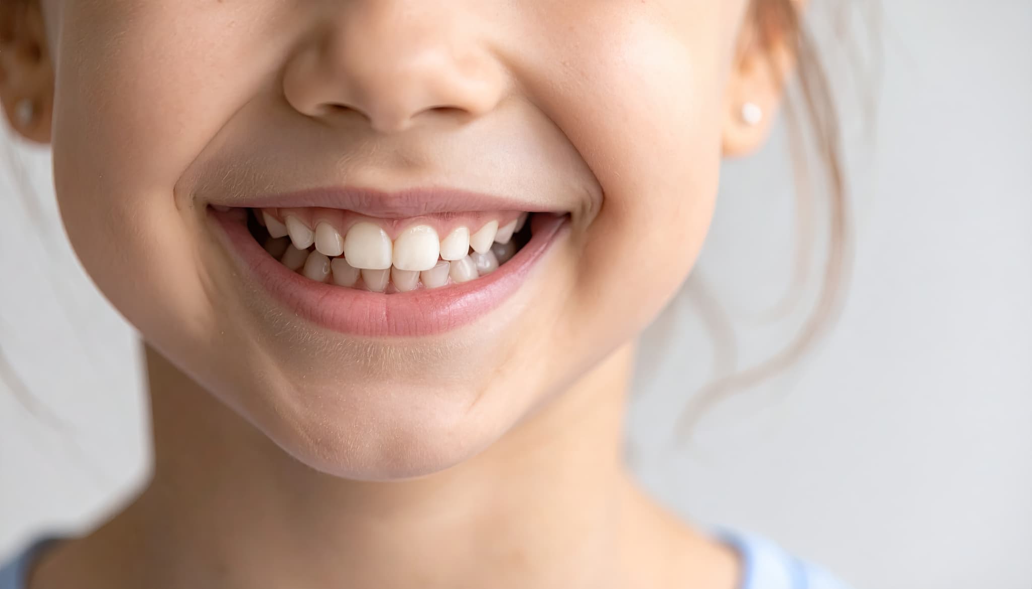 受け口を矯正し笑顔になる子ども