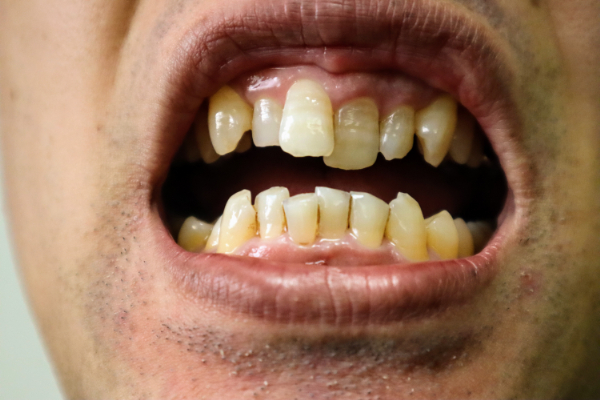 マウスピースで矯正治療できない歯並びの男性