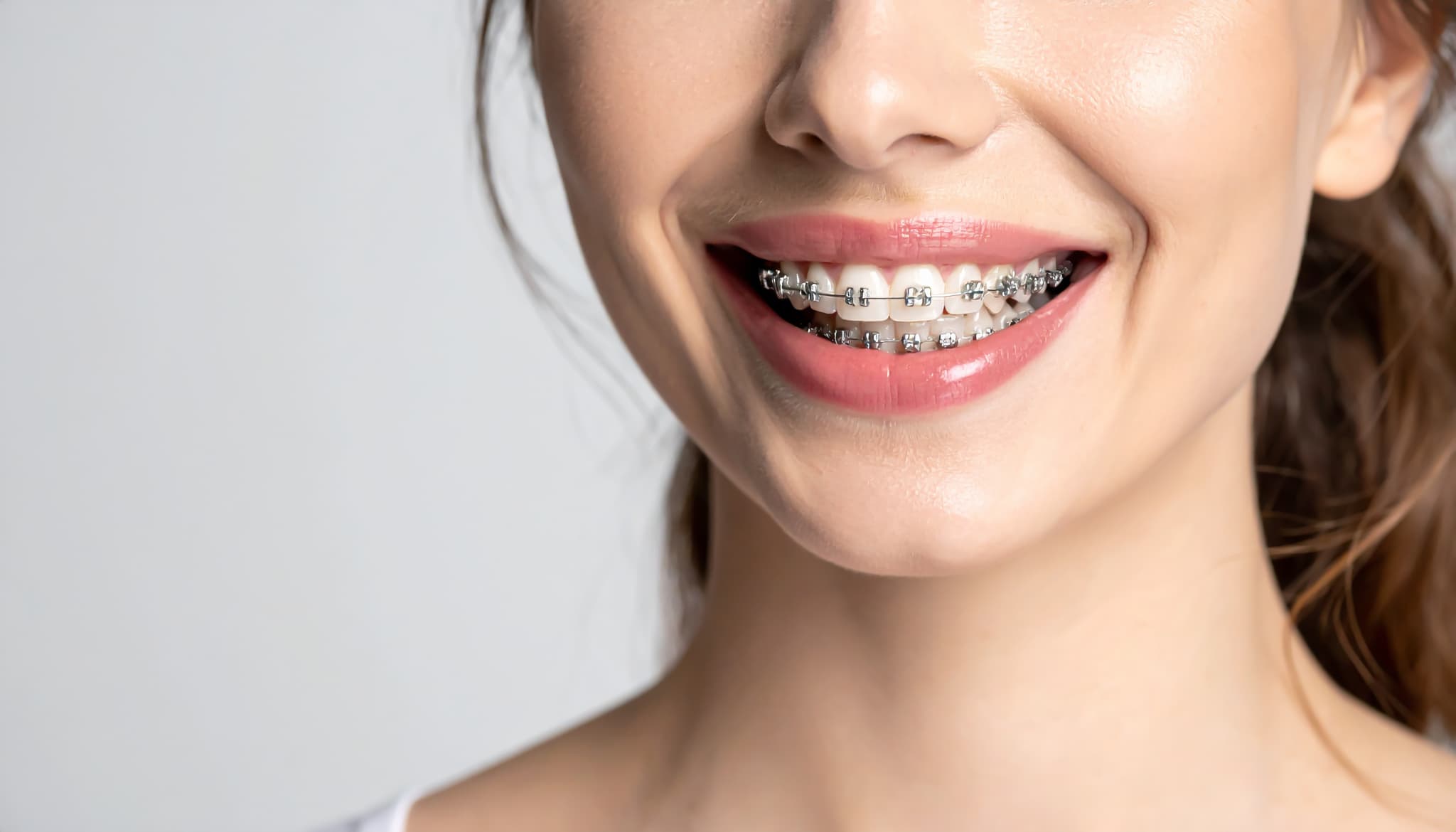 ワイヤー矯正を始めた女性の口元