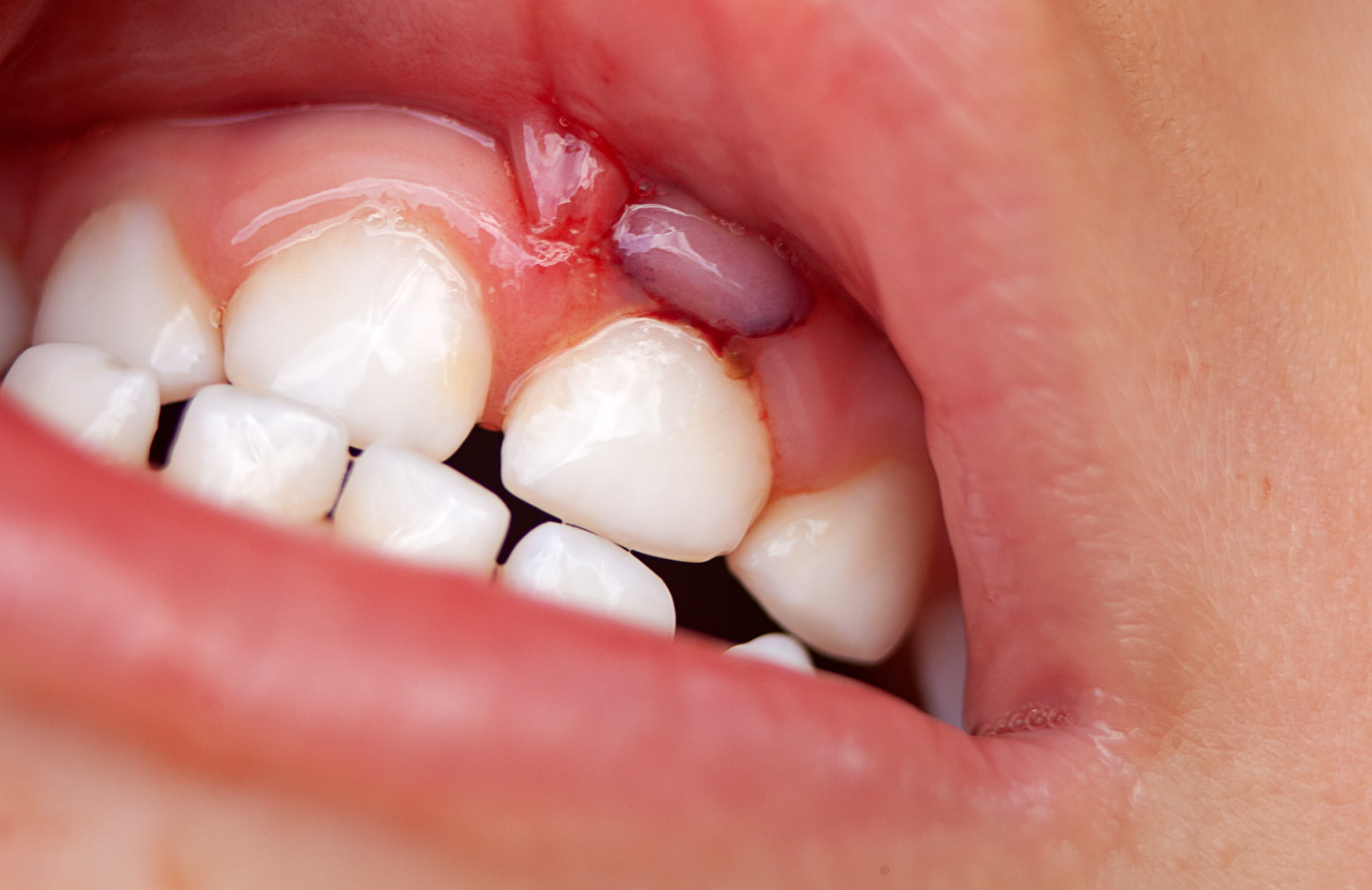 歯肉炎のイメージ