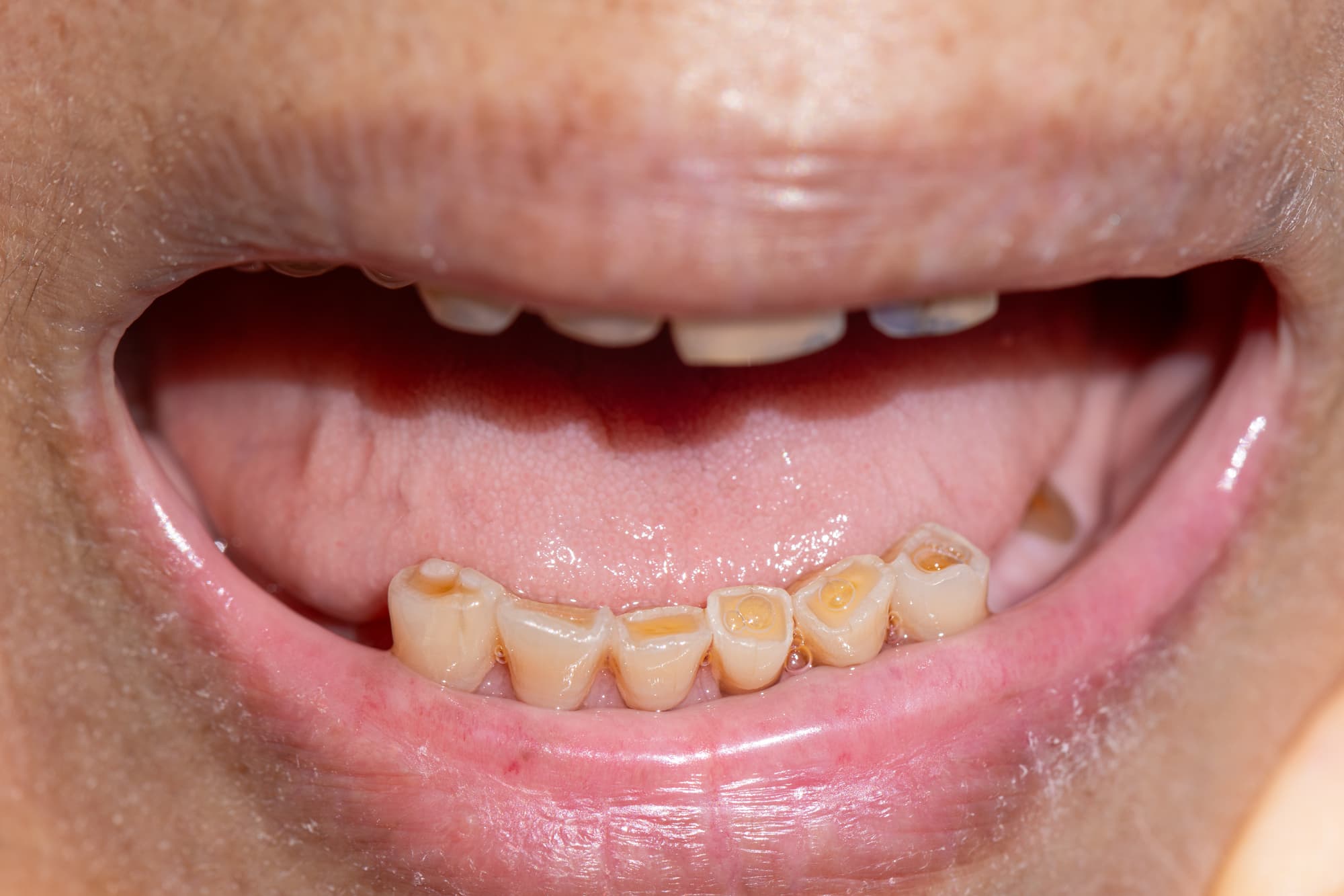 歯ぎしりで摩耗した歯