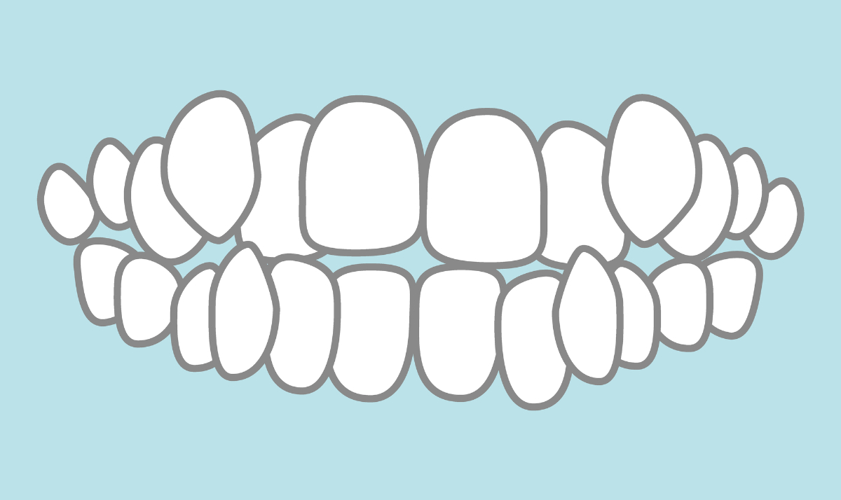叢生の状態の歯