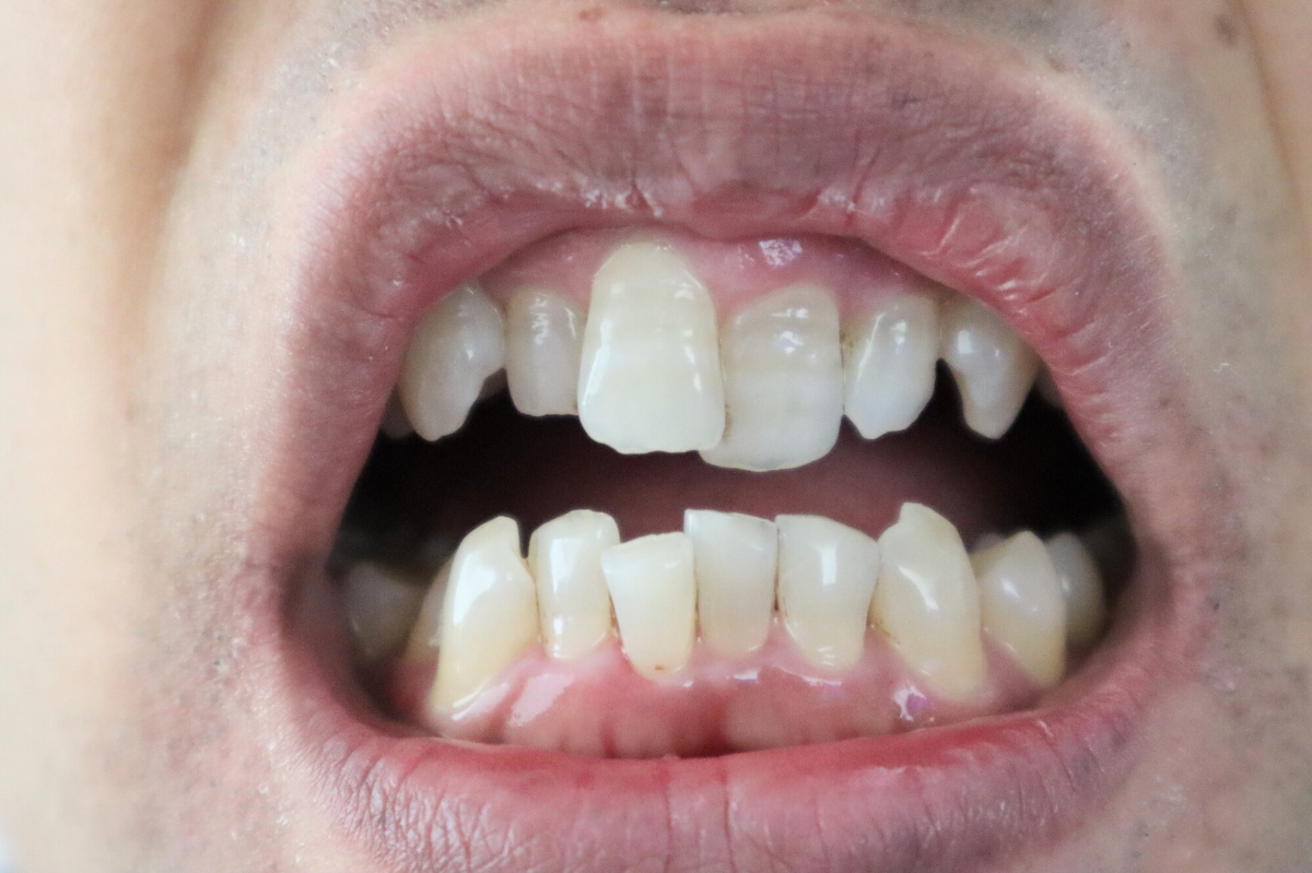 叢生の状態の歯
